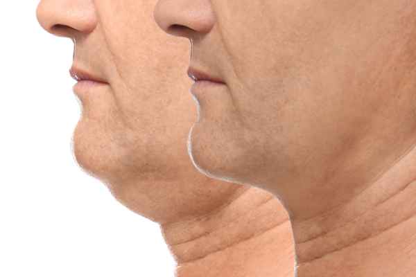 HIFU - Breakthrough in Anti - ageing 2 hifu results Brackley