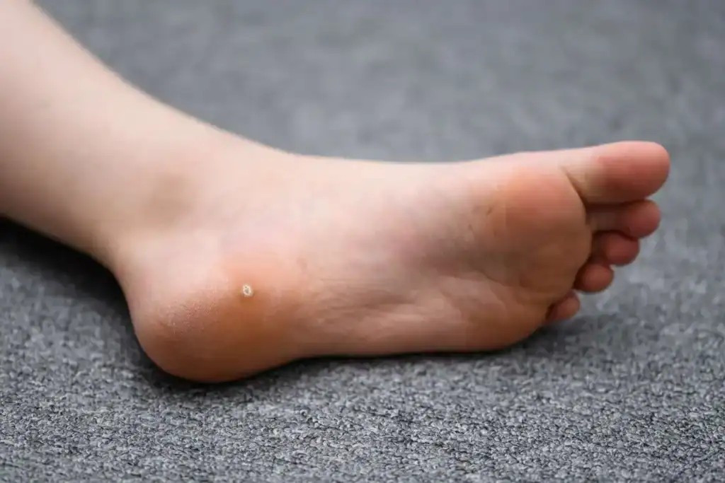 Cryotherapy For Warts And Also Verrucas 2 Image of verruca on the bottom of the foot that able to be treated with Cryotherapy Brackley
