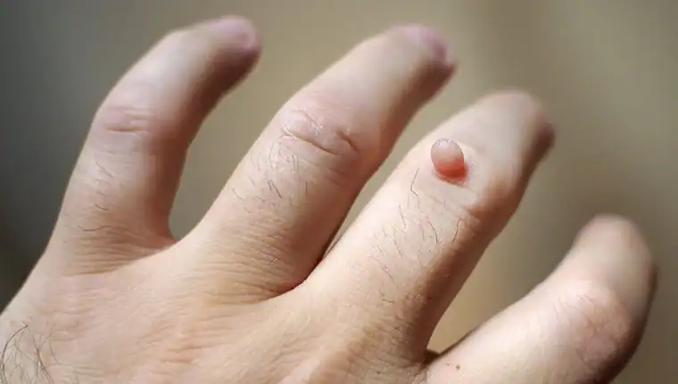 Cryotherapy For Warts And Also Verrucas 1 Image of blemish that Cryotherapy Brackley can remove with Lipo 360.