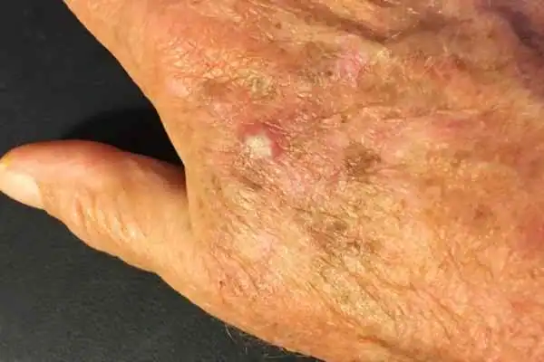 Image of Actinic keratoses Brackley on a person hand