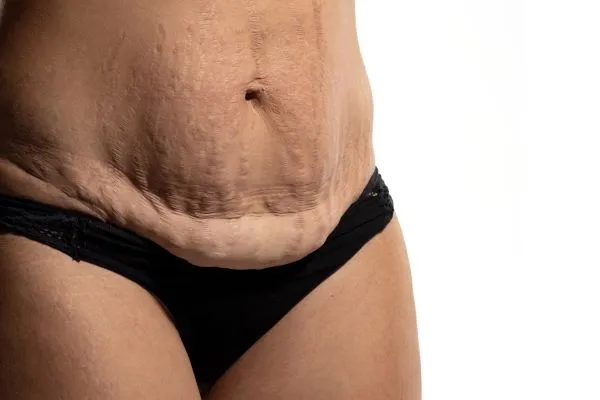 The Science of Skin Tightening 1 The science behind skin tightening Brackley picture of a woman's sagging skin on the stomach